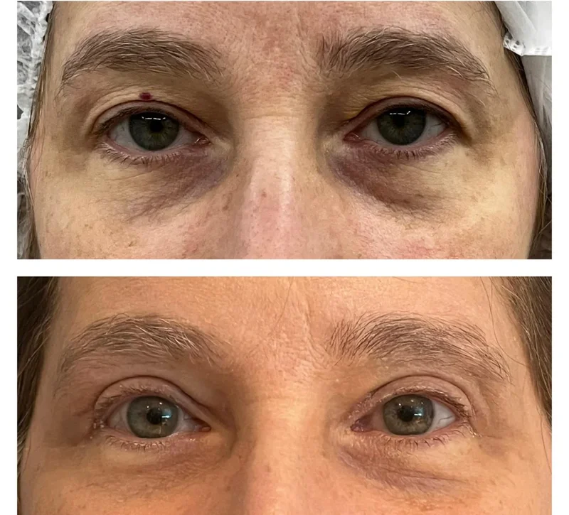 Imagem comparativa de caso real de ptose palpebral 11