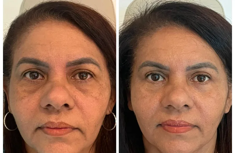 Imagem comparativa de caso real de ptose palpebral 16