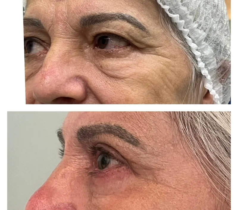 Imagem comparativa de caso real de ptose palpebral 18