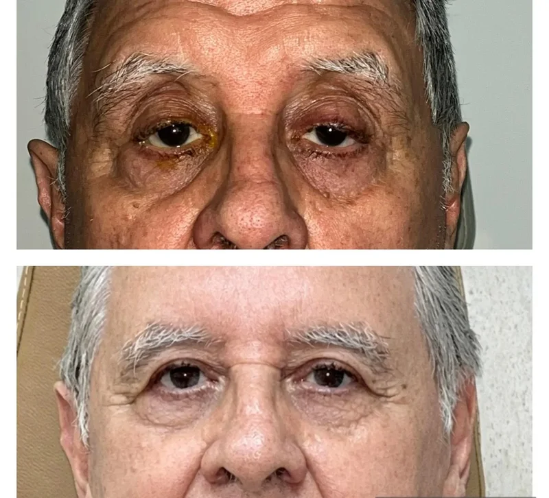 Registro clínico de correção de ptose palpebral 3