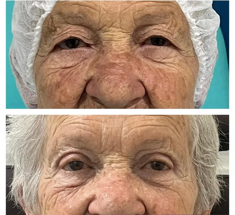 Imagem comparativa de caso real de ptose palpebral 6