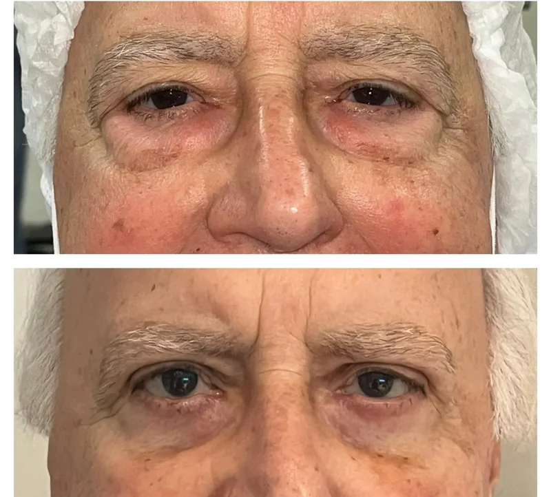 Imagem comparativa de caso real de ptose palpebral 7