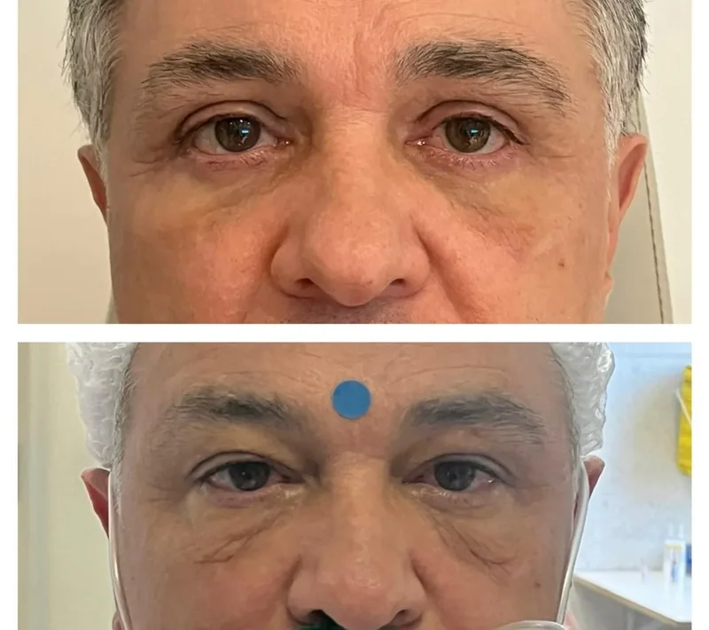 Imagem comparativa de caso real de ptose palpebral 8